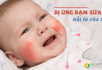 Cách nhận biết trẻ bị dị ứng với đạm sữa bò và gợi ý về loại sữa thay thế
