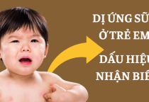 DỊ ỨNG SỮA Ở TRẺ EM – DẤU HIỆU NHẬN BIẾT - CÁCH XỬ LÝ
